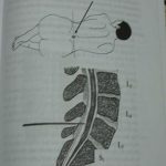 Kỹ Thuật Chọc Dò Tủy Sống 1