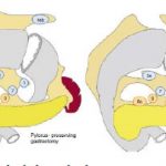 Phác Đồ Hướng Dẫn Điều Trị Ung Thư Dạ Dày 4