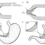 Phác Đồ Hướng Dẫn Điều Trị Ung Thư Dạ Dày 5