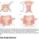 Phác Đồ Điều Trị, Phẫu Thuật Sa Trực Tràng 2