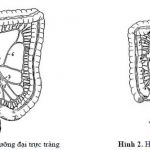 Điều Trị Phẫu Thuật Ngoại Khoa Ung Thư Đại Tràng Trực Tràng