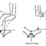 Điều Trị Phẫu Thuật Ngoại Khoa Ung Thư Đại Tràng Trực Tràng 6