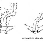Điều Trị Phẫu Thuật Ngoại Khoa Ung Thư Đại Tràng Trực Tràng 7