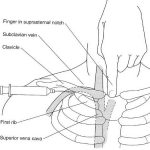 Đặt Catheter Tĩnh Mạch Trung Tâm 1