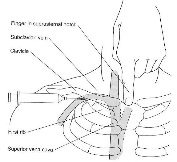 Đặt Catheter Tĩnh Mạch Trung Tâm