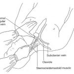 Đặt Catheter Tĩnh Mạch Trung Tâm 3