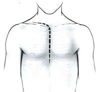 Các Đường Mở Ngực Trong Phẫu Thuật Tim Mạch - Lồng Ngực