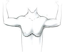 Các Đường Mở Ngực Trong Phẫu Thuật Tim Mạch - Lồng Ngực